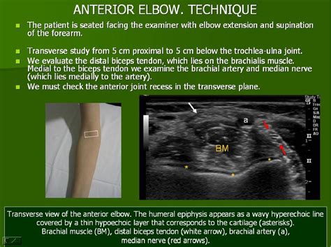 Figure 20 from Ultrasound of the elbow, what the radiologist should ...