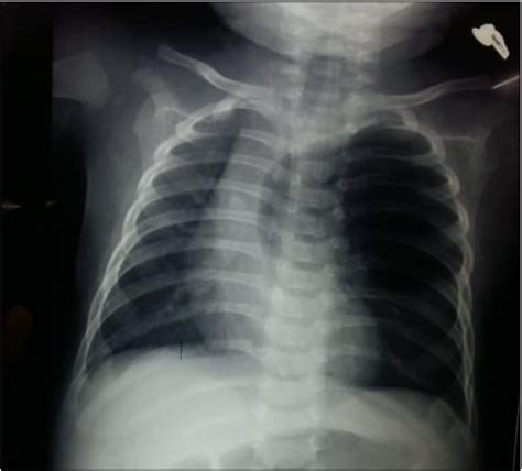 Figure From A Case Report Of Congenital Lobar Emphysema Semantic