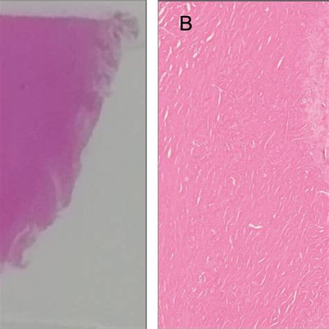 Histopathological Features Of Autopsyderived Lung Tissue Obtained From