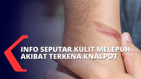 Informasi Seputar Luka Bakar Dan Kulit Melepuh Akibat Terkena Knalpot