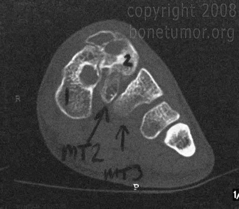 Giant Cell Tumor Foot And Ankle