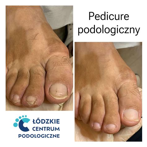 Pedicure leczniczy Łódzkie Centrum Podologiczne