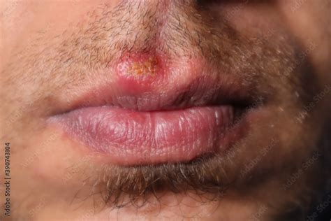 Herpes Simplex Virus Hsv Mouth Infection Herpes Simplex Virus Type 1