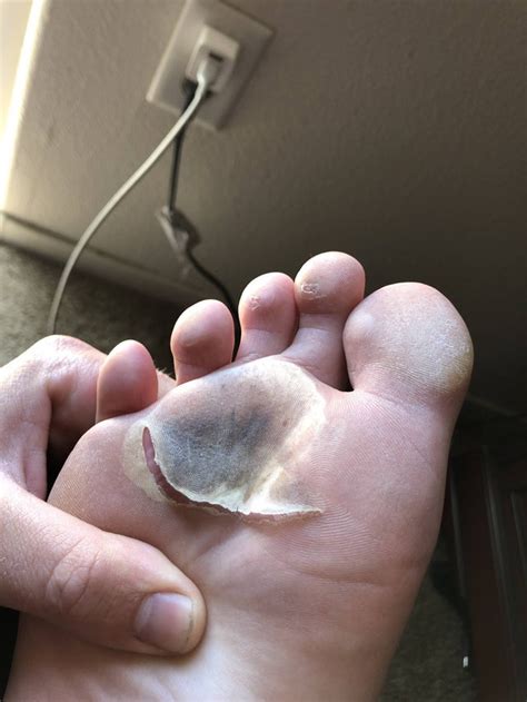 One Week After A Hot Pavement Foot Race Blister Its Clean The Dead