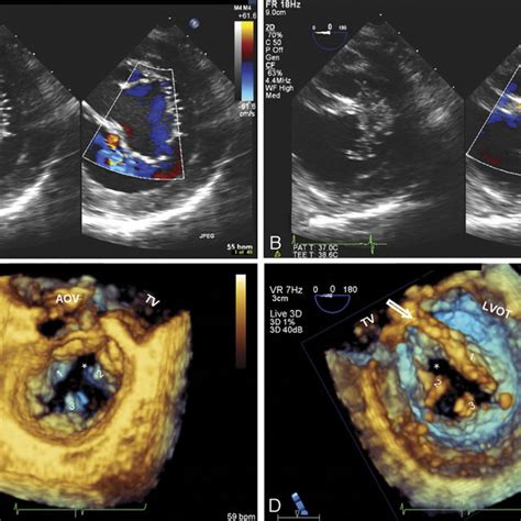 A And B Two Dimensional Transesophageal Echocardiography