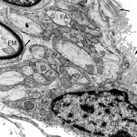 Intraoperative Image Of The Implantation Of The Acellular Nerve