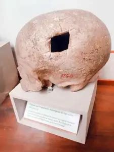 Trepanaciones Craneanas De La Cultura Paracas