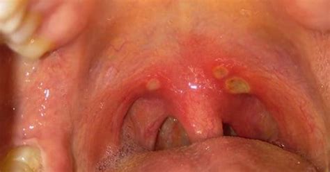 How To Cure Canker Sore On Tonsils Asap