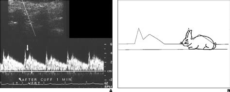 Figure 1 From A Spectrum Of Doppler Waveforms In The Carotid And Vertebral Arteries Semantic