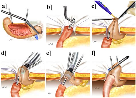 Gastroduodenostomy Tool