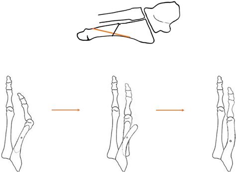 Comparison Of Oblique Fifth Metatarsal Osteotomies For The Management