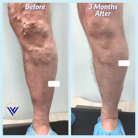 How Long Is The Recovery Period After Varicose Vein Treatment Center