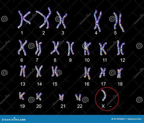 Turner S-syndrome Karyotype Royalty-Free Cartoon | CartoonDealer.com #81595802