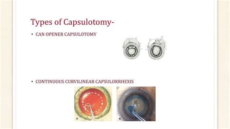 Cataract surgery past present future | PPT