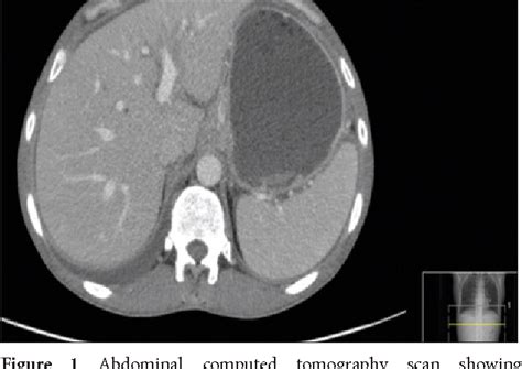 Figure 1 From A Rare Case Of Burkitts Lymphoma Of The Duodenal Bulb