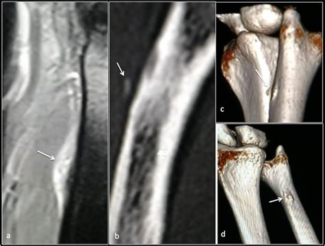 Calcific Tendinopathy Of The Pronator Quadratus Muscle A Rare Site And