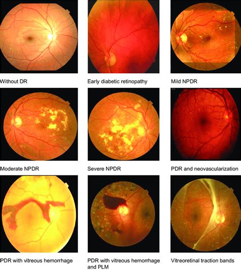 Severe Nonproliferative Diabetic Retinopathy