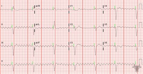 Paced Rhythms Ecg Stampede