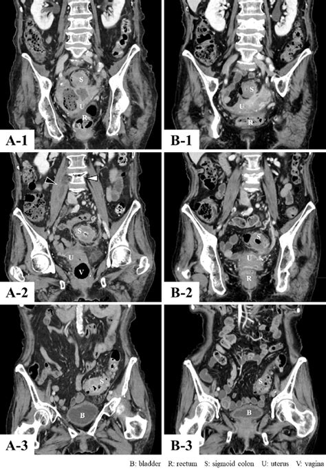 Figure1 Abdominal And Pelvic Contrast Enhanced Ct At Day 1 A And Day Download Scientific