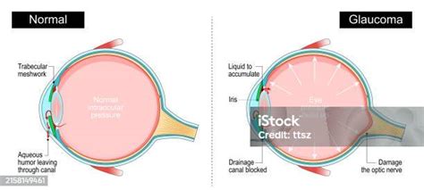 Ilustración De Glaucoma Sección Transversal De Un Ojo Humano Y Más