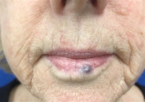 Benign Lesion Removal — Tokarz Dermatology