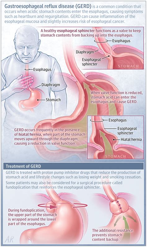 Gastroesophageal Reflux Disease Gastroenterology Jama Jama Network