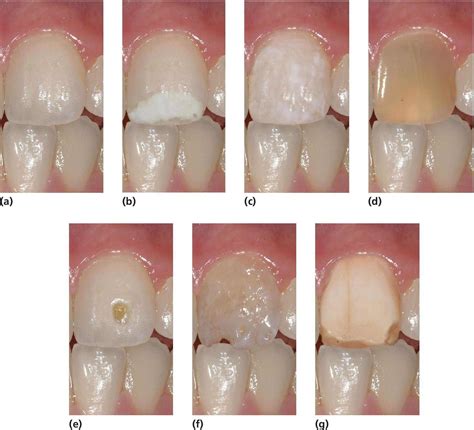 20 Developmental Defects Of The Dental Hard Tissues And Their