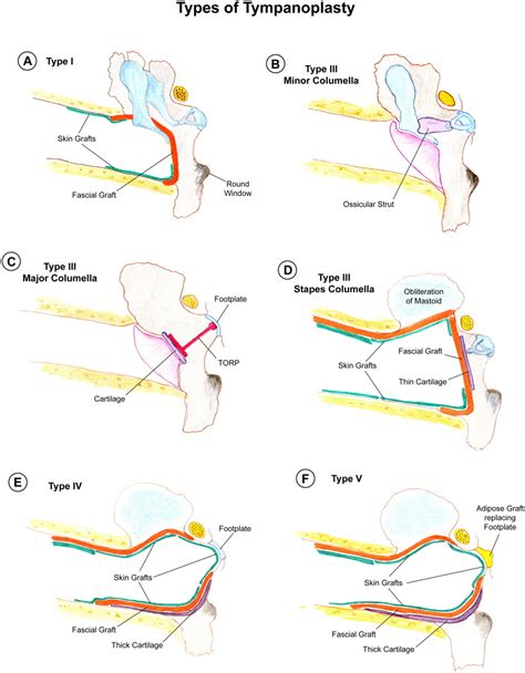 Tympanoplasty Operative Techniques In Otolaryngology Head And Neck