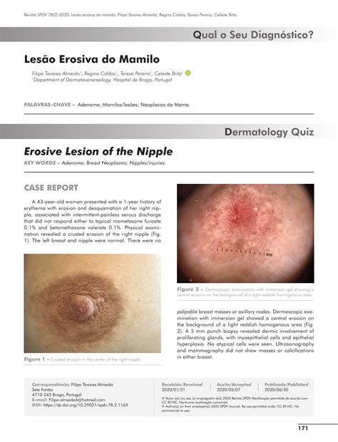 Pdf Erosive Lesion Of The Nipple