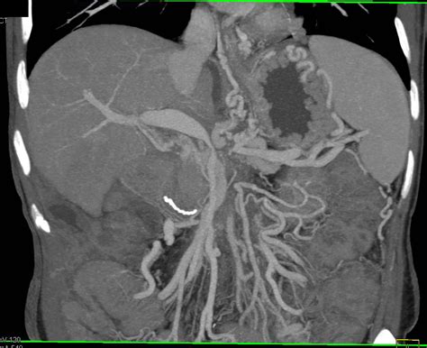 Pancreatic Cancer Encases The Portal Vein Smv Splenic Vein Junction