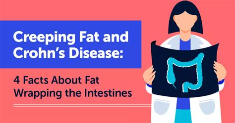 Creeping Fat and Crohn’s Disease: 4 Facts About Fat Wrapping the Intestines | MyCrohnsAndColitisTeam