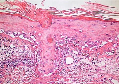 Histologic Aspect Of Subacute With Intense Hydropic Degeneration Of