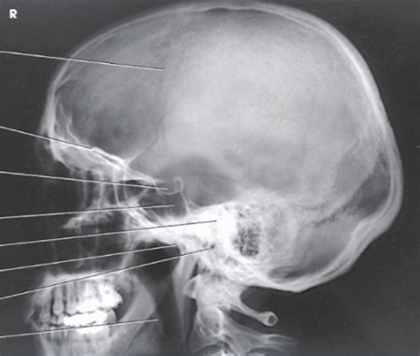 Lateral Skull Anatomy Radiograph Diagram Quizlet