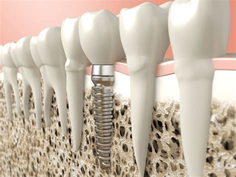 Dental Implant Procedure What You Need To Know