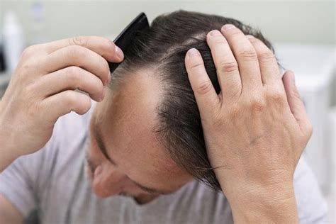 Qu Es La Alopecia Por Tracci N Te Ayudamos Capilclinic