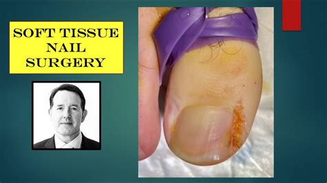 Video Soft Tissue Nail Procedure Youtube