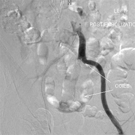 Post Embolization Run Showed Occlusion Of Internal Iliac Artery Using