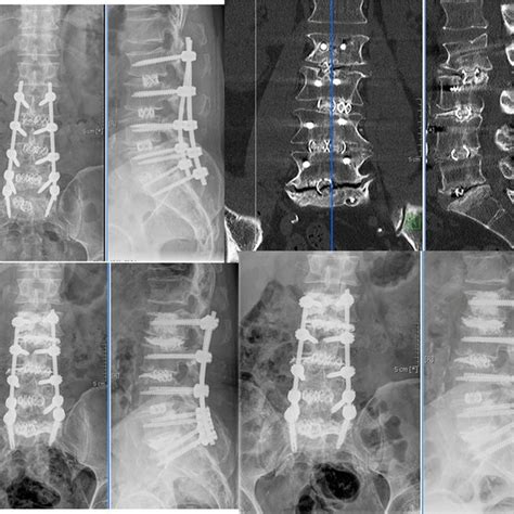 Plains X Rays 14 Months After Posterior Lumbar Interbody Fusion In Download Scientific Diagram