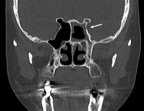 Findings of postoperative ostiomeatal unit CT. Disappearance of... | Download Scientific Diagram