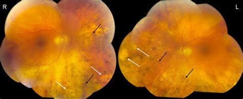 Autoimmune Retinopathy In Systemic Lupus Erythematosus Histopathologic Features