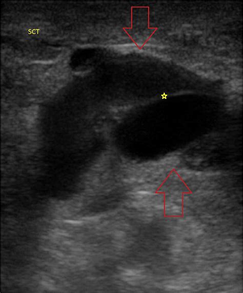 A Patient With Massive Localized Lymphedema Journal Of Emergency Medicine