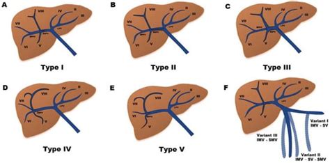 Jcm Free Full Text Portal Vein Thrombosis In The Setting Of