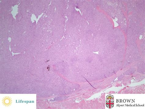 Alveolar Soft Part Sarcoma | Pathology Residency and Fellowship Program ...