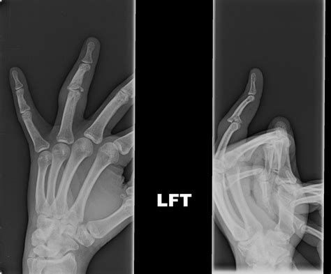 Xray Of Broken Finger