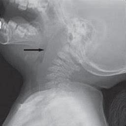 diagnosis  penatalaksanaan abses leher