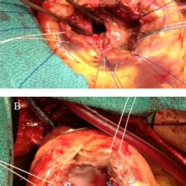 Intraoperative Photography Showing The Anterior Ventricular Septal