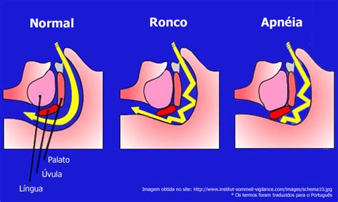 ortoatual O que é Apnéia do Sono e Tratamento