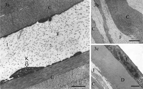 In TEM micrographs, the dystrophic stroma is seen with lamellae of ...