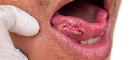 Oral Cancer Causes Symptoms Diagnosis And Treatment