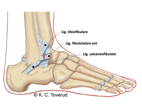 Ligamentskade Ankel BevApp